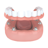 Animated implant supported denture icon